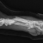 Lateral view of metacarpal fractures