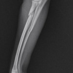 Proximal Radius fracture with "green stick" Ulna fracture.